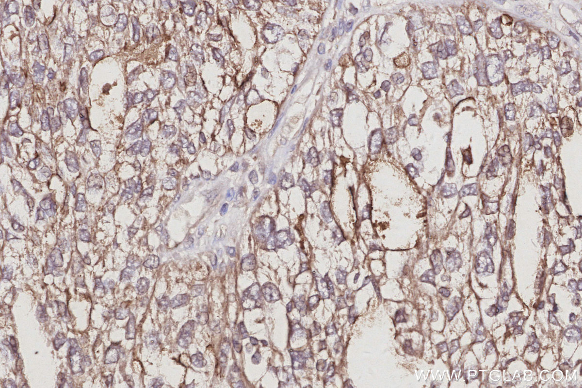 Immunohistochemical analysis of paraffin-embedded human ovary cancer tissue slide using KHC3049 (IRSp53 IHC Kit). Immunohistochemical analysis of paraffin-embedded human ovary cancer tissue slide using KHC3049 (IRSp53 IHC Kit).