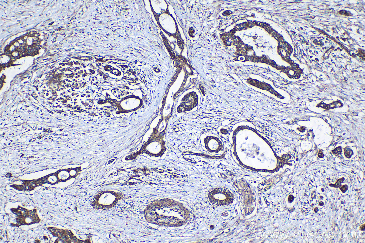 Immunohistochemical analysis of paraffin-embedded human pancreas cancer tissue slide using KHC1259 (ISCU IHC Kit).