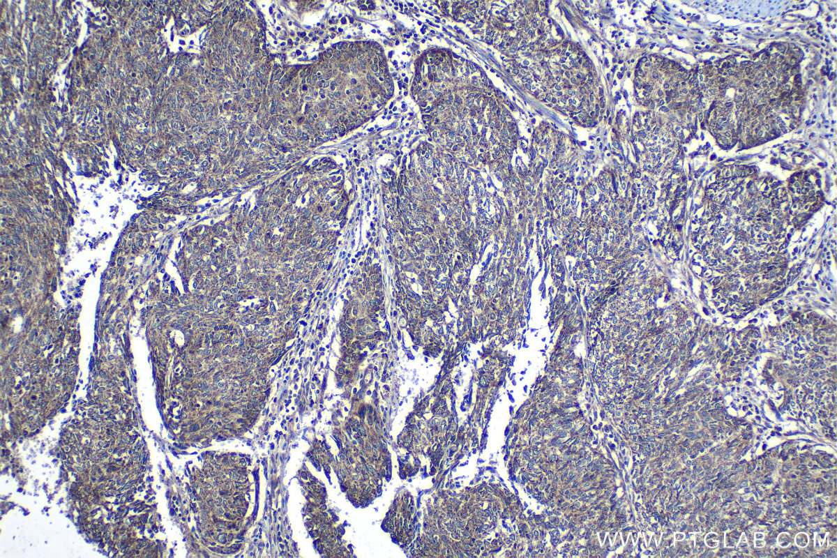 Immunohistochemical analysis of paraffin-embedded human cervical cancer tissue slide using KHC1259 (ISCU IHC Kit).