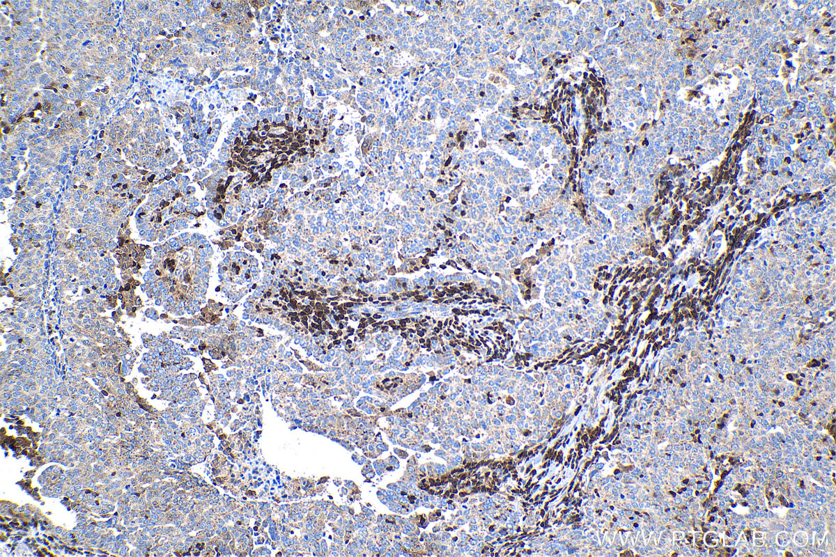 Immunohistochemical analysis of paraffin-embedded human ovary tumor tissue slide using KHC1342 (ISG20 IHC Kit).