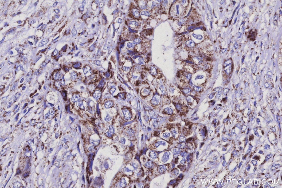 Immunohistochemical analysis of paraffin-embedded human pancreas cancer tissue slide using KHC3129 (ISOC2 IHC Kit).