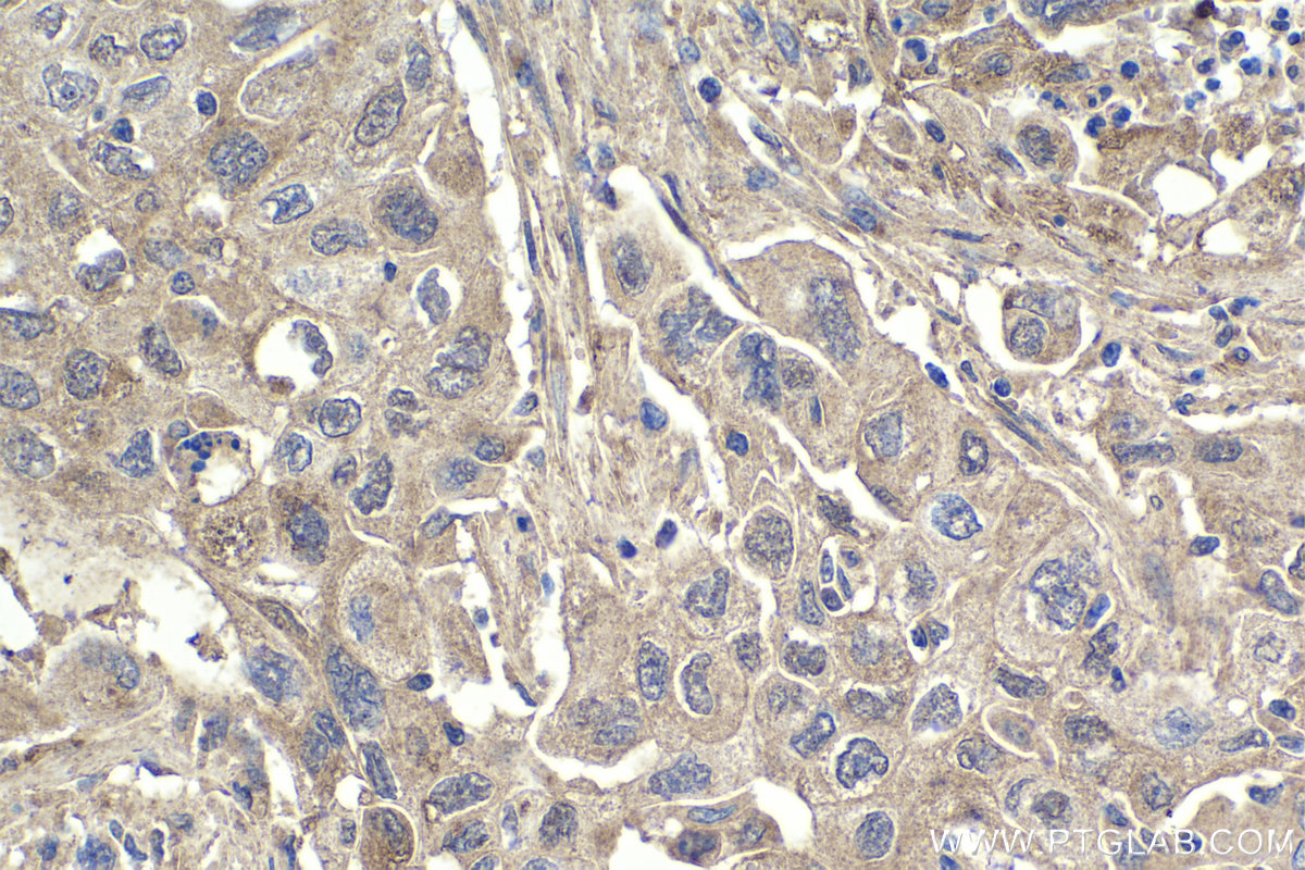 Immunohistochemical analysis of paraffin-embedded human lung cancer tissue slide using KHC1875 (ITCH IHC Kit).