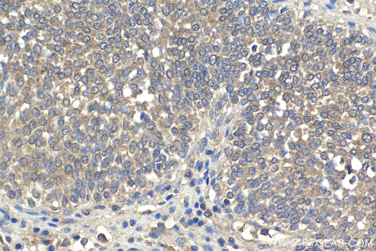 Immunohistochemical analysis of paraffin-embedded human urothelial carcinoma tissue slide using KHC1875 (ITCH IHC Kit).