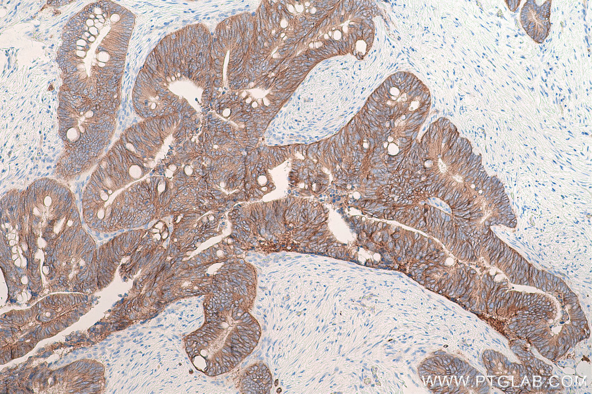 Immunohistochemical analysis of paraffin-embedded human colon cancer tissue slide using KHC0800 (ITGB4 IHC Kit).