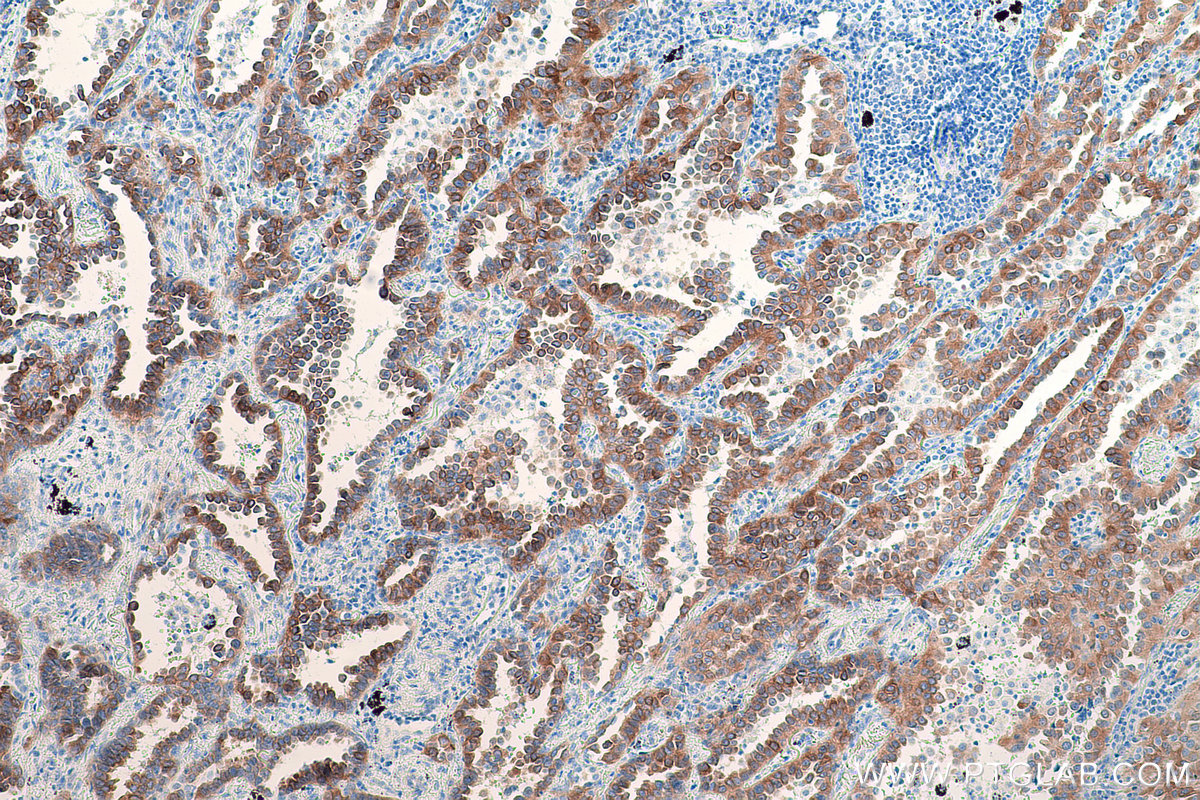 Immunohistochemical analysis of paraffin-embedded human lung cancer tissue slide using KHC0800 (ITGB4 IHC Kit).