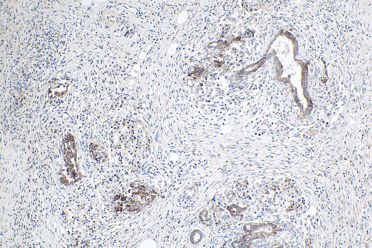 Immunohistochemical analysis of paraffin-embedded human pancreas cancer tissue slide using KHC0221 (Integrin Beta 6 IHC Kit).