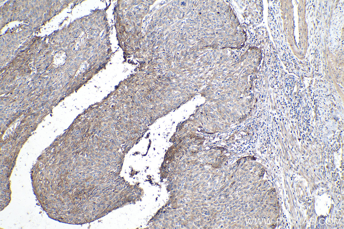 Immunohistochemical analysis of paraffin-embedded human cervical cancer tissue slide using KHC0221 (Integrin Beta 6 IHC Kit).