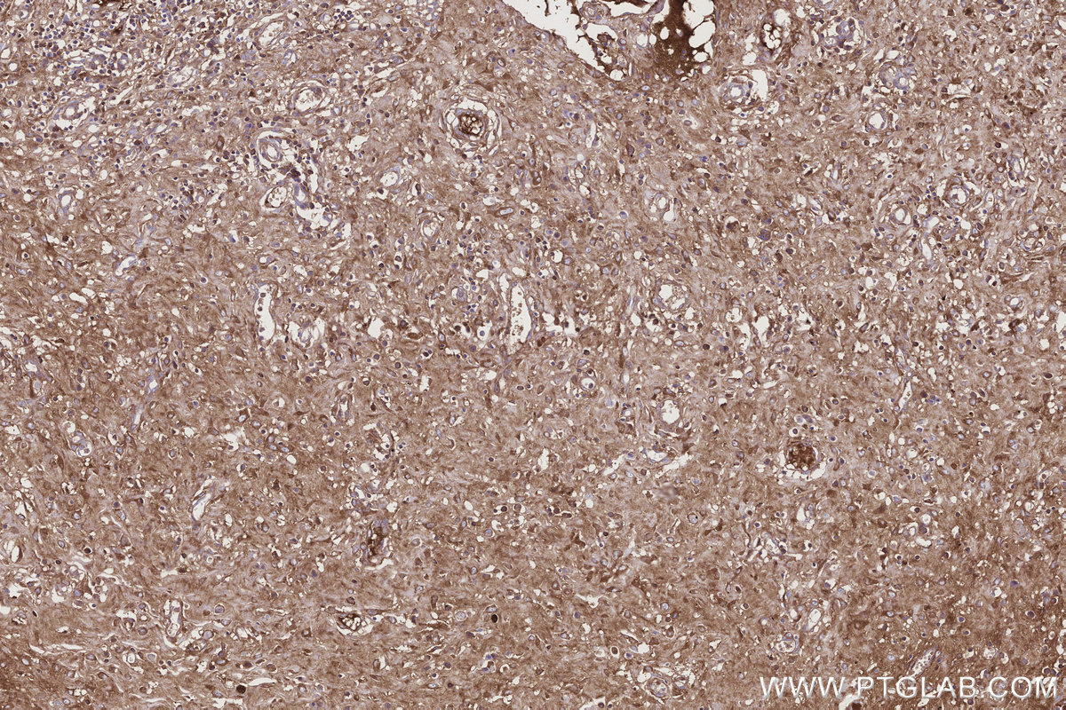 Immunohistochemical analysis of paraffin-embedded human colon cancer tissue slide using KHC3196 (ITIH1 IHC Kit). Immunohistochemical analysis of paraffin-embedded human colon cancer tissue slide using KHC3196 (ITIH1 IHC Kit).
