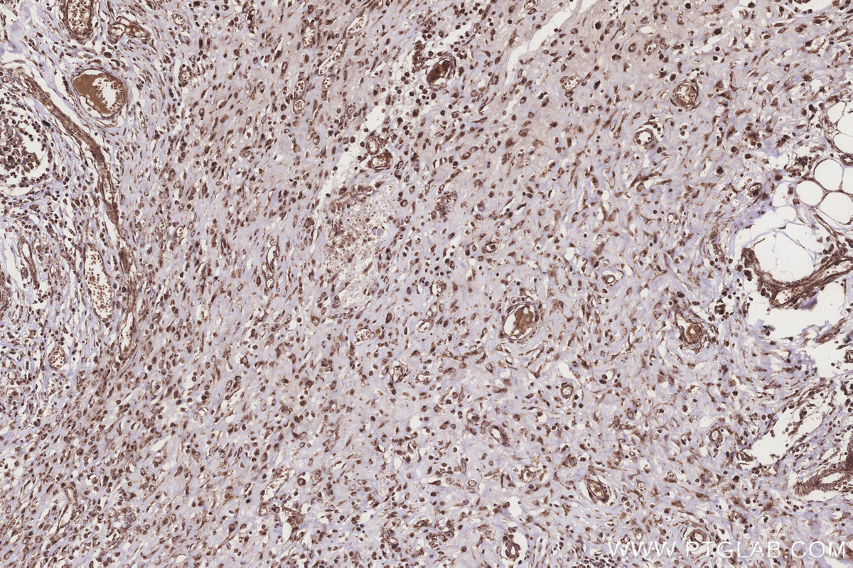 Immunohistochemical analysis of paraffin-embedded human colon cancer tissue slide using KHC3202 (IVD IHC Kit).