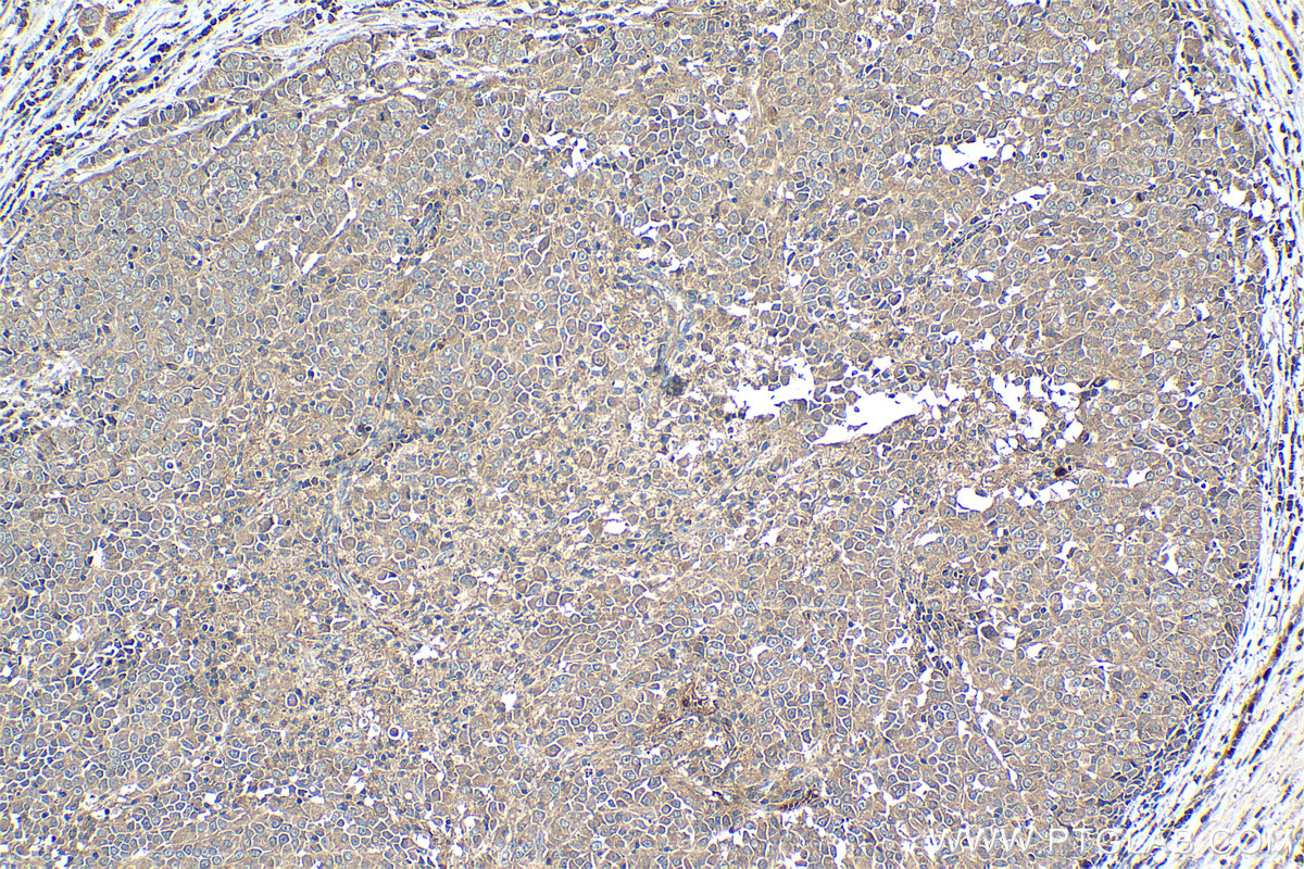 Immunohistochemical analysis of paraffin-embedded human ovary tumor tissue slide using KHC1264 (JAK1 IHC Kit).