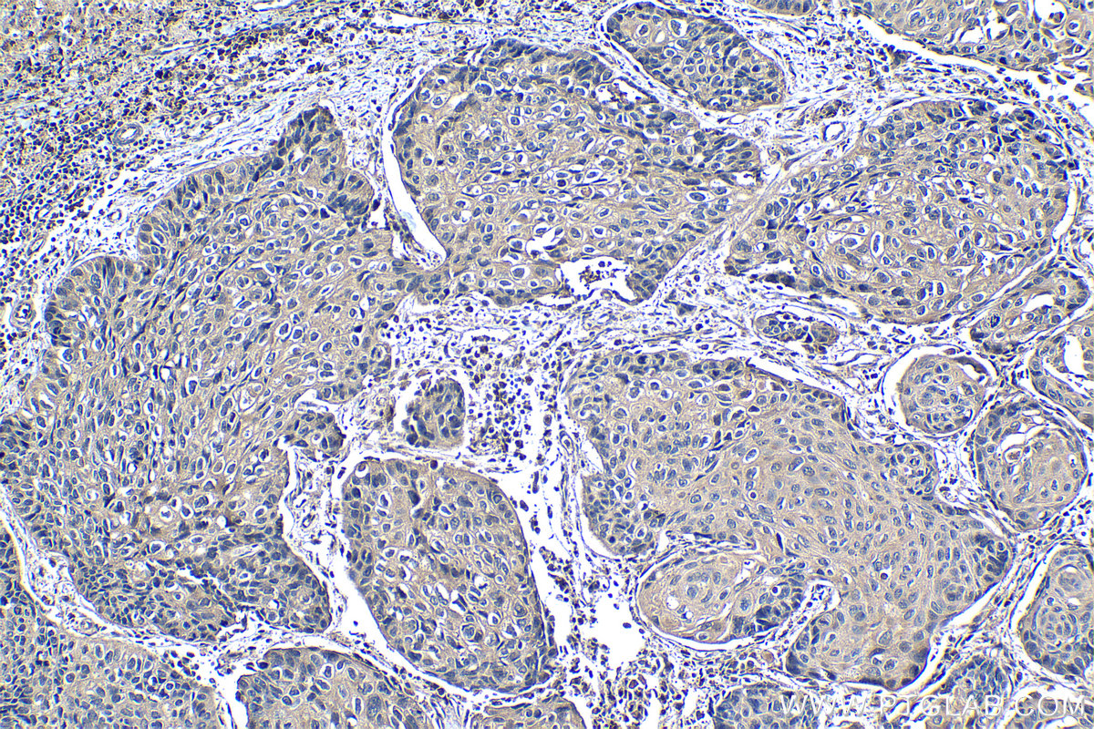 Immunohistochemical analysis of paraffin-embedded human lung cancer tissue slide using KHC1264 (JAK1 IHC Kit).