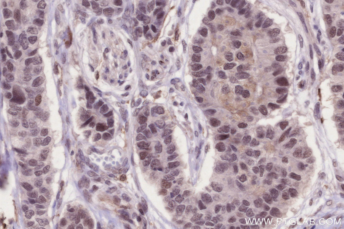 Immunohistochemical analysis of paraffin-embedded human stomach cancer tissue slide using KHC2672 (JMJD5 IHC Kit).