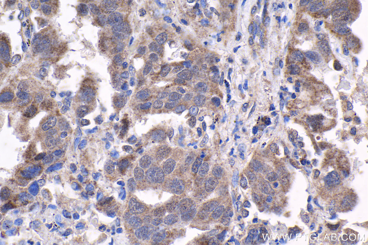 Immunohistochemical analysis of paraffin-embedded human lung cancer tissue slide using KHC1734 (KANK1 IHC Kit).