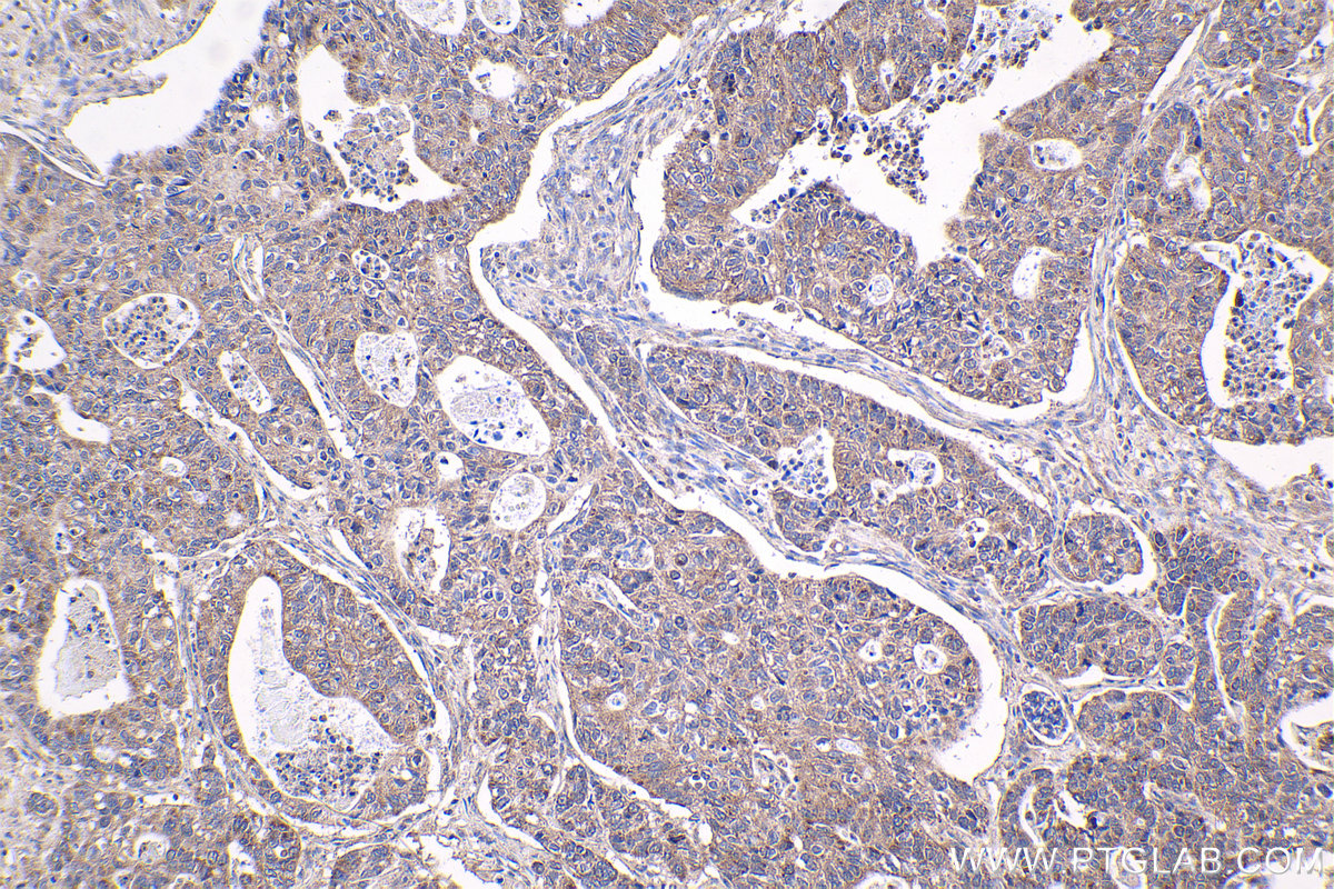 Immunohistochemical analysis of paraffin-embedded human stomach cancer tissue slide using KHC1734 (KANK1 IHC Kit).