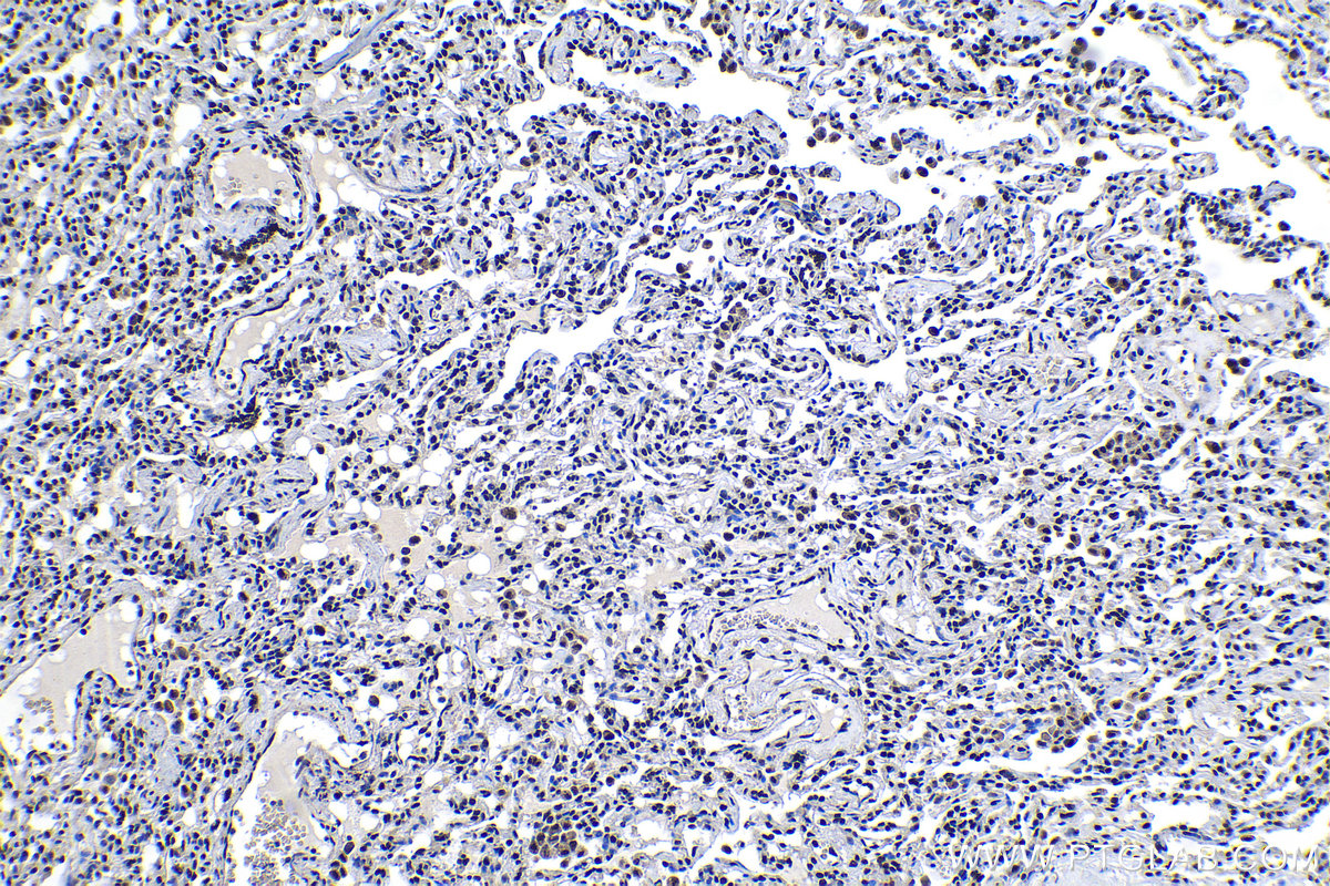 Immunohistochemical analysis of paraffin-embedded human lung cancer tissue slide using KHC1178 (KAP1 IHC Kit).