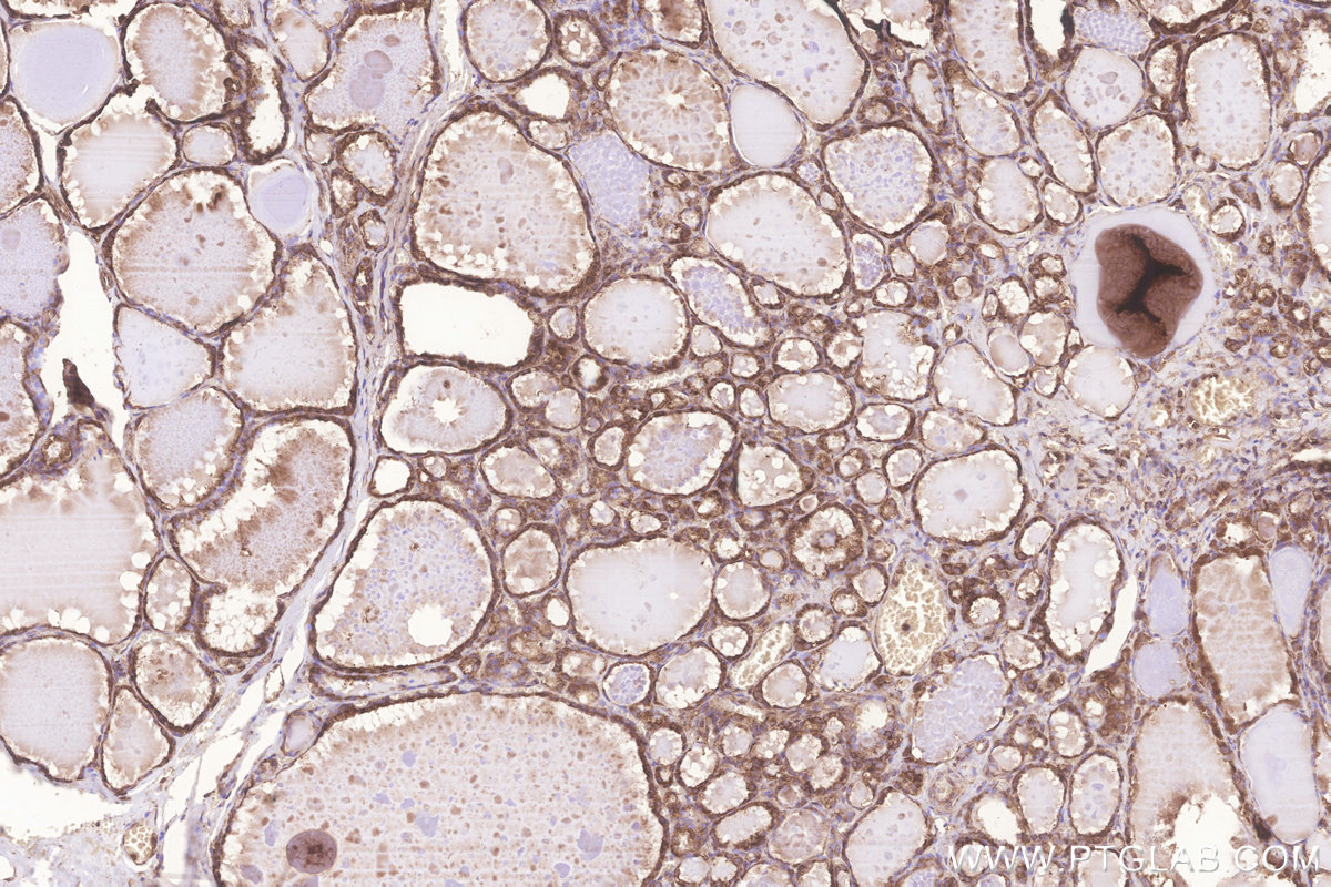 Immunohistochemical analysis of paraffin-embedded human thyroid cancer tissue slide using KHC3255 (KARS IHC Kit).
