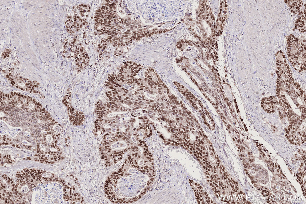 Immunohistochemical analysis of paraffin-embedded human stomach cancer tissue slide using KHC2761 (KAT2A/GCN5 IHC Kit).