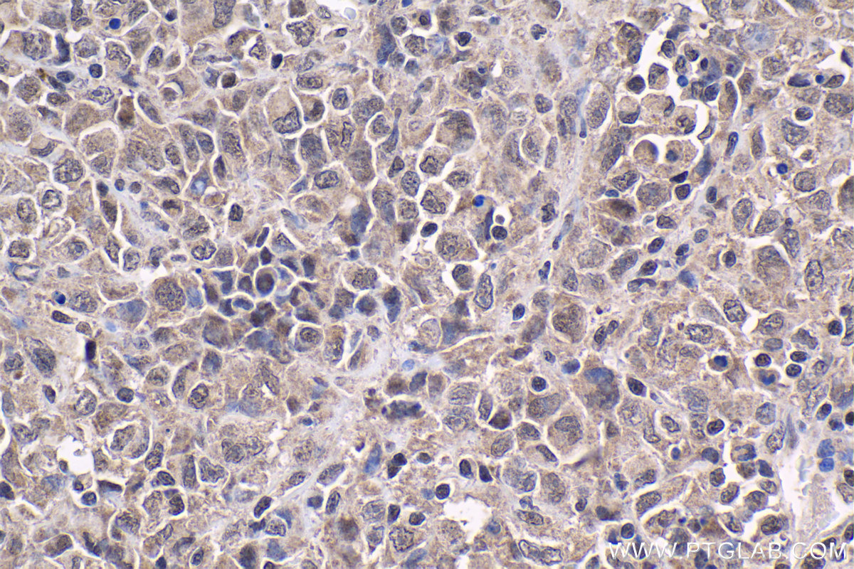 Immunohistochemical analysis of paraffin-embedded human malignant melanoma tissue slide using KHC1862 (KAT5 IHC Kit).