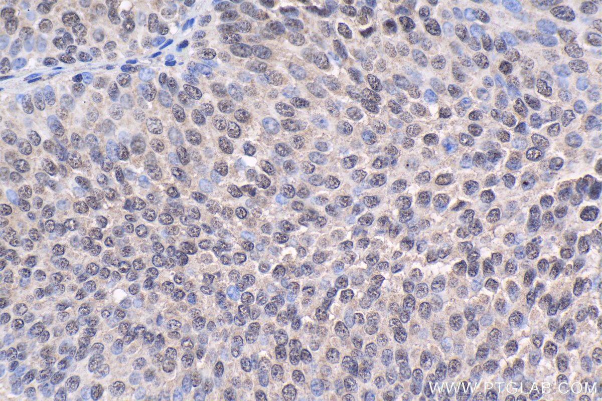 Immunohistochemical analysis of paraffin-embedded human urothelial carcinoma tissue slide using KHC1862 (KAT5 IHC Kit).