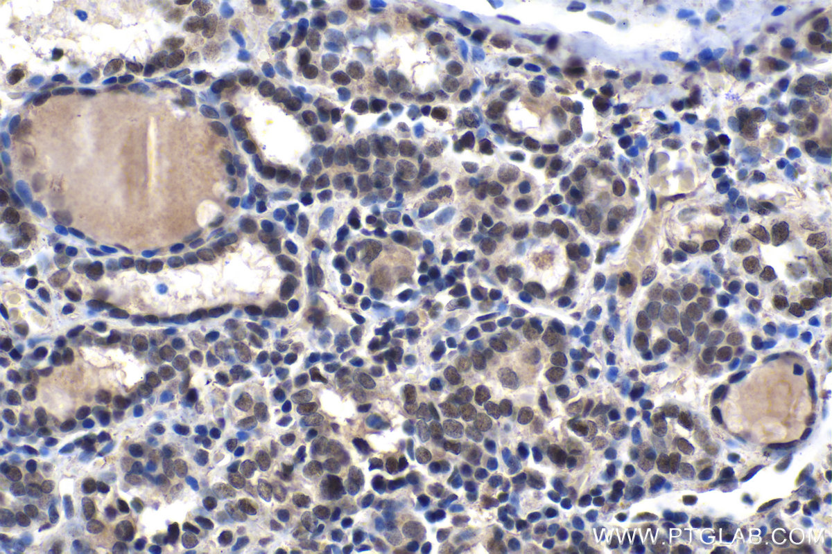 Immunohistochemical analysis of paraffin-embedded human thyroid cancer tissue slide using KHC1491 (KAT7/MYST2 IHC Kit).