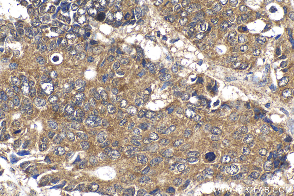 Immunohistochemical analysis of paraffin-embedded human stomach cancer tissue slide using KHC2113 (KATNA1 IHC Kit).