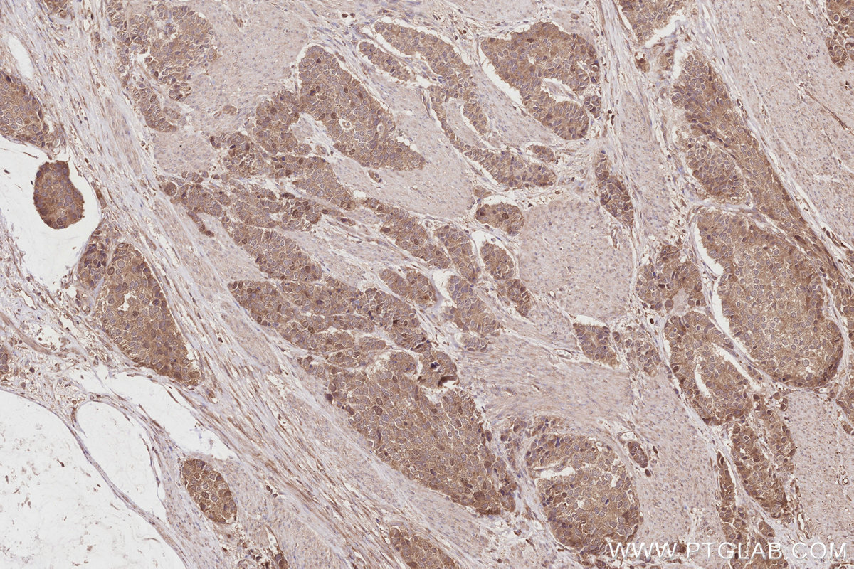Immunohistochemical analysis of paraffin-embedded human stomach cancer tissue slide using KHC2873 (KATNB1 IHC Kit).