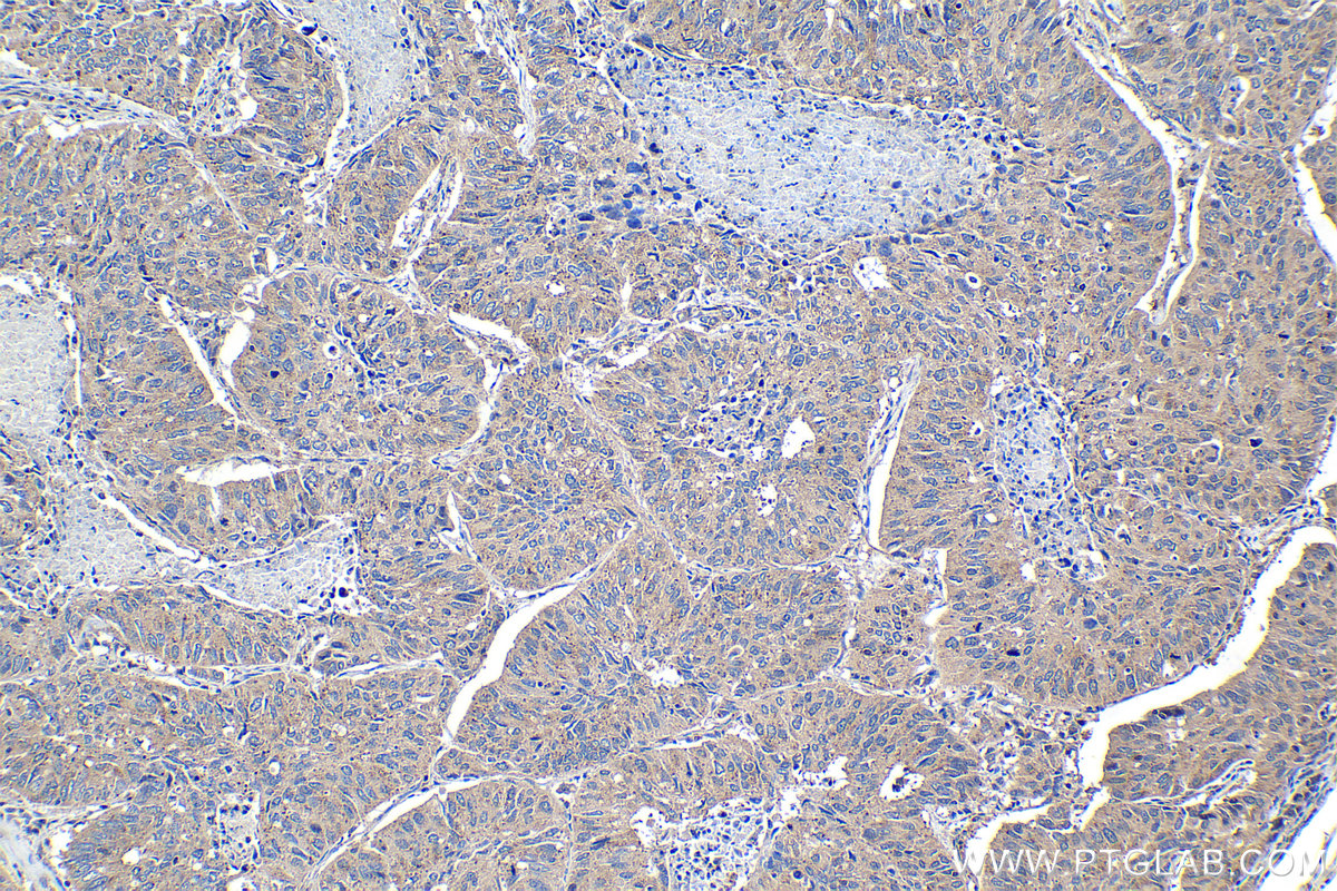 Immunohistochemical analysis of paraffin-embedded human lung cancer tissue slide using KHC1064 (KEAP1 IHC Kit).