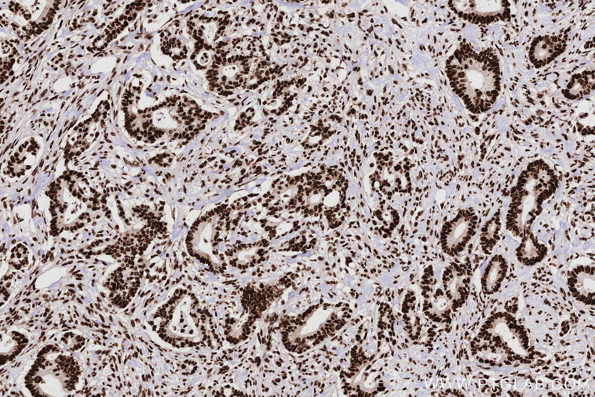 Immunohistochemical analysis of paraffin-embedded human rectal cancer tissue slide using KHC2767 (KHSRP IHC Kit).