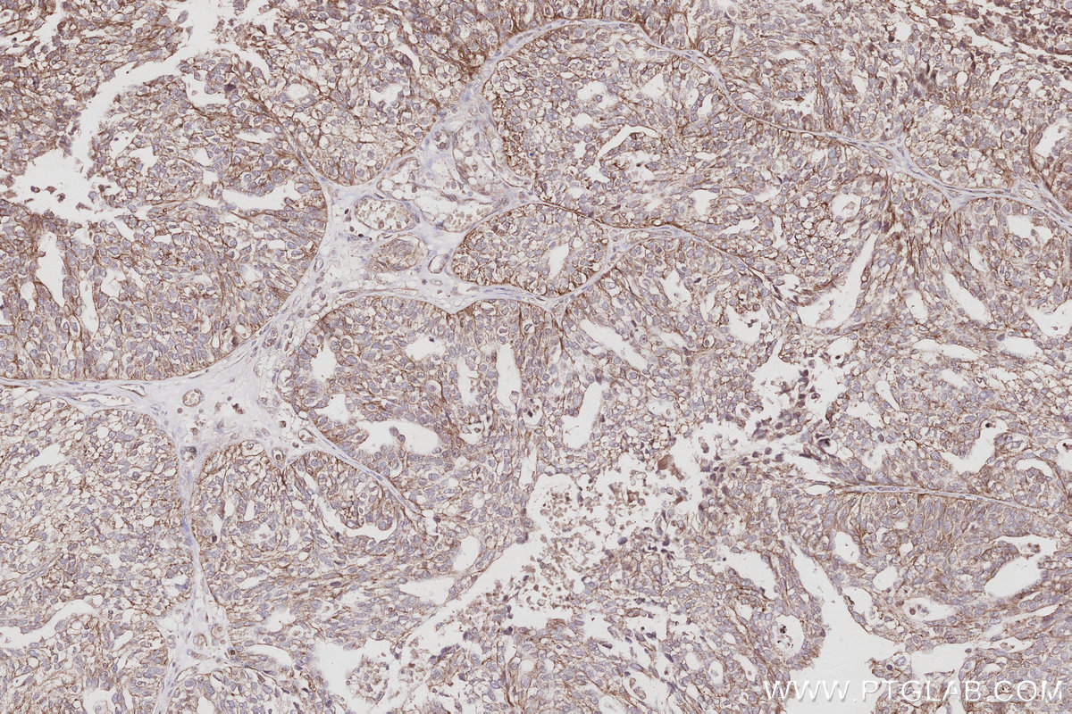 Immunohistochemical analysis of paraffin-embedded human ovary cancer tissue slide using KHC3036 (KIDINS220 IHC Kit). Immunohistochemical analysis of paraffin-embedded human ovary cancer tissue slide using KHC3036 (KIDINS220 IHC Kit).