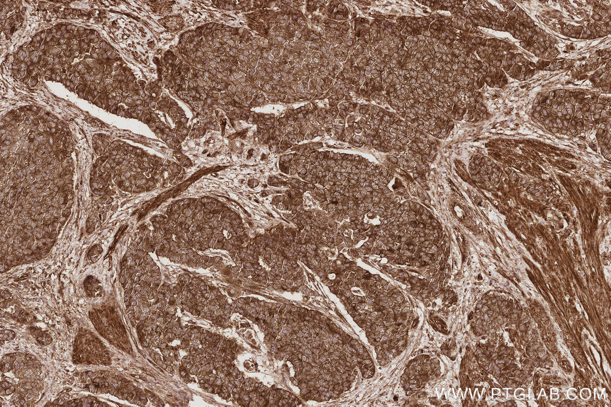 Immunohistochemical analysis of paraffin-embedded human stomach cancer tissue slide using KHC2903 (KIF13A IHC Kit).
