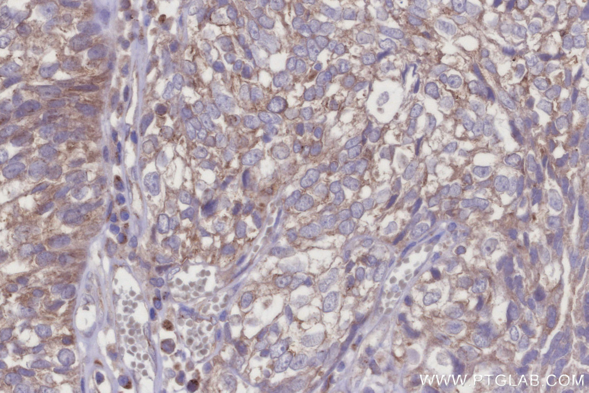 Immunohistochemical analysis of paraffin-embedded human ovary cancer tissue slide using KHC2951 (KIF15 IHC Kit).