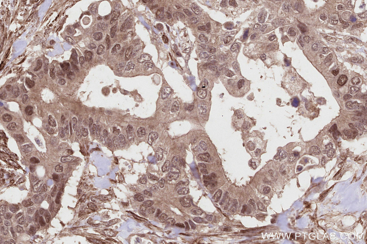Immunohistochemical analysis of paraffin-embedded human rectal cancer tissue slide using KHC2820 (KIF20B IHC Kit).