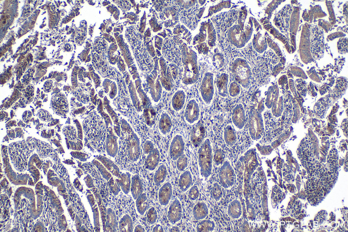 Immunohistochemical analysis of paraffin-embedded human stomach cancer tissue slide using KHC1268 (KIF26B IHC Kit).