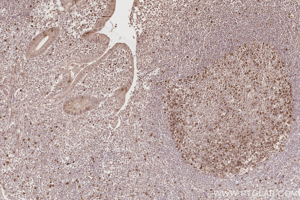 Immunohistochemical analysis of paraffin-embedded human appendicitis tissue slide using KHC2845 (KIF2C IHC Kit).