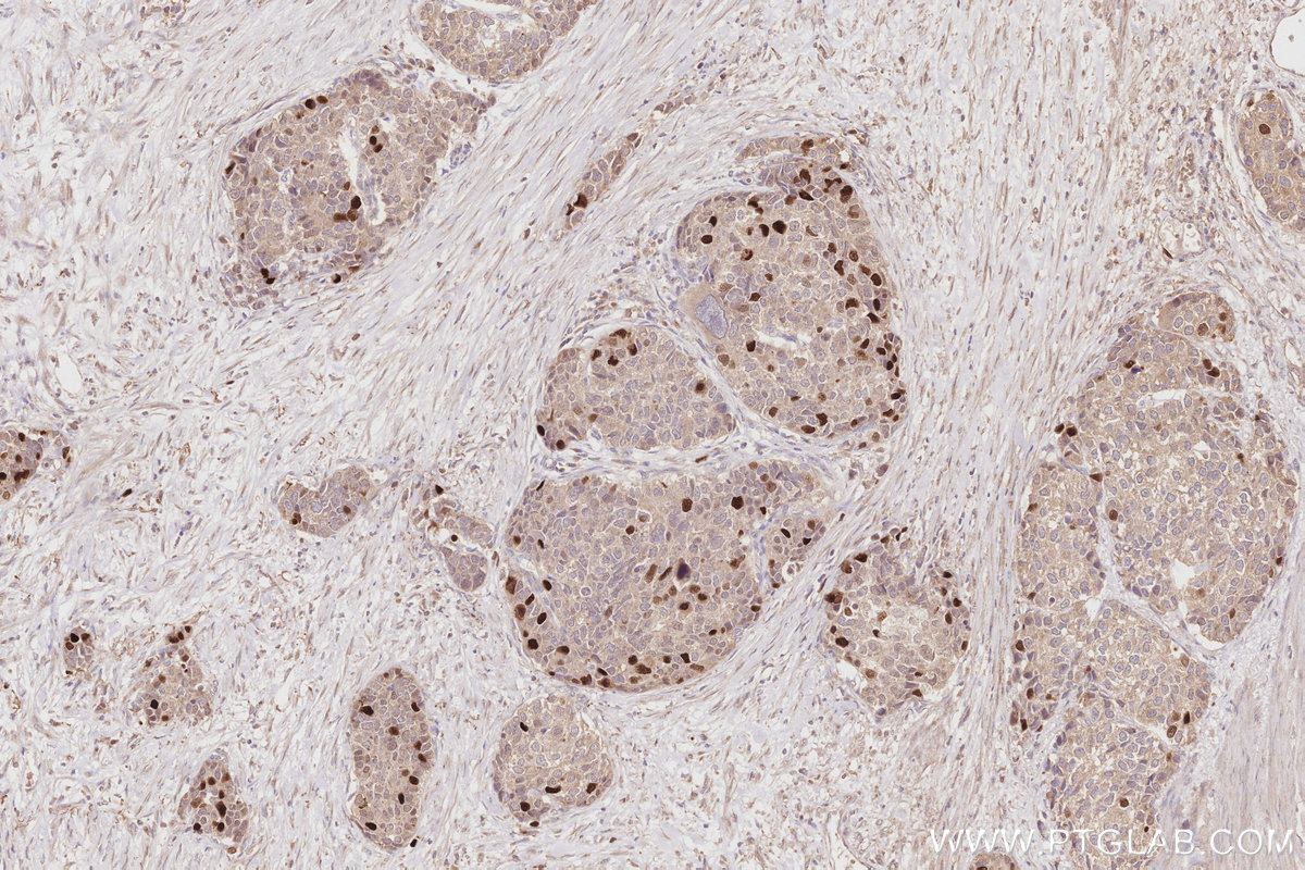 Immunohistochemical analysis of paraffin-embedded human stomach cancer tissue slide using KHC2876 (KIFC1 IHC Kit).