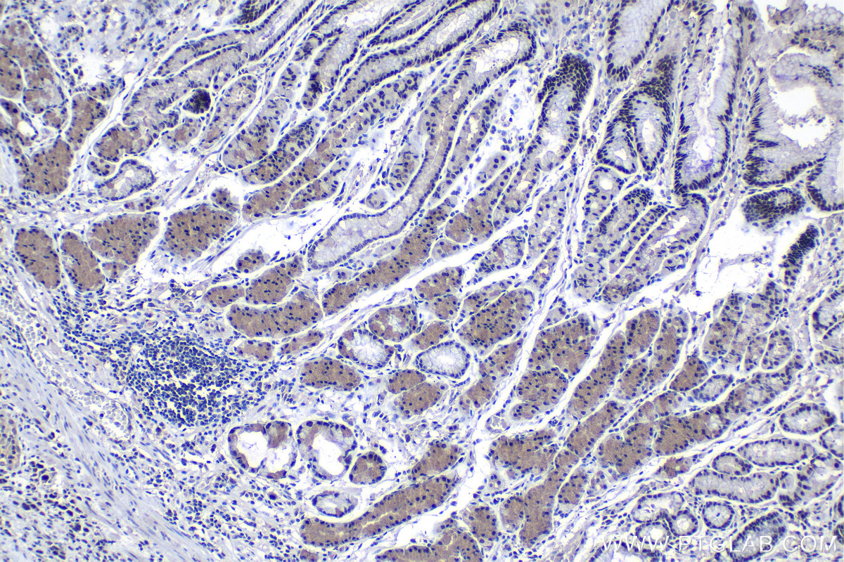 Immunohistochemical analysis of paraffin-embedded human stomach cancer tissue slide using KHC1242 (KPNA3 IHC Kit).