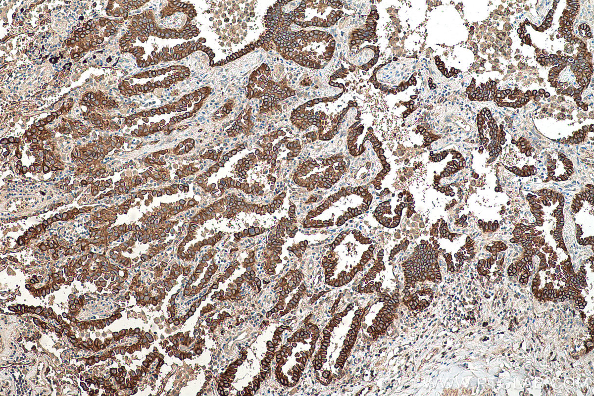 Immunohistochemical analysis of paraffin-embedded human lung cancer tissue slide using KHC0582 (KRT10 IHC Kit).