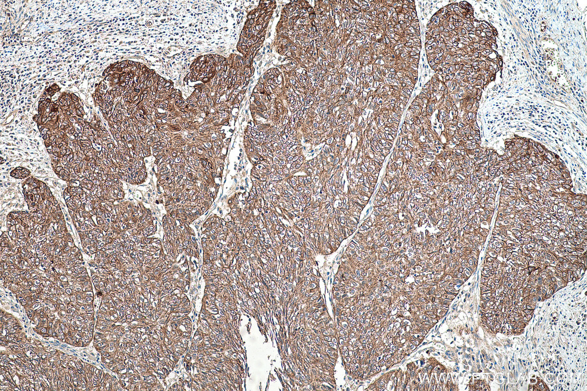 Immunohistochemical analysis of paraffin-embedded human cervical cancer tissue slide using KHC0582 (KRT10 IHC Kit).