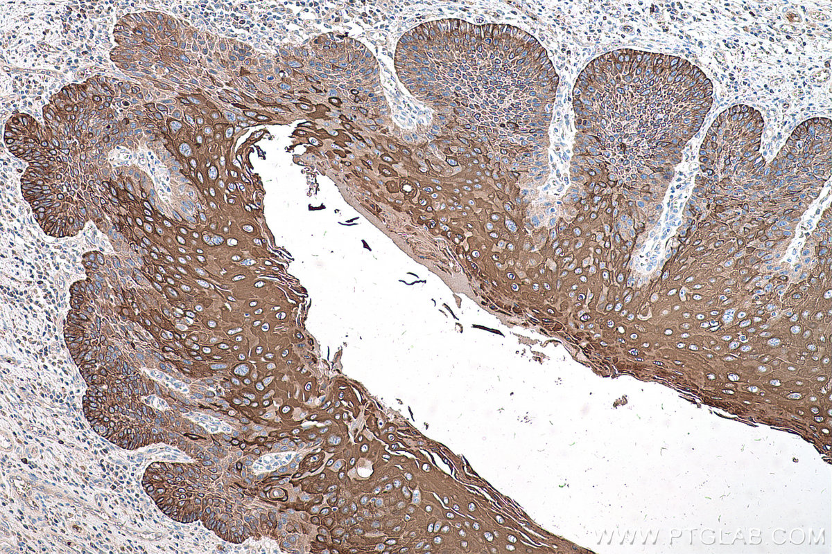 Immunohistochemical analysis of paraffin-embedded human oesophagus cancer tissue slide using KHC0582 (KRT10 IHC Kit).