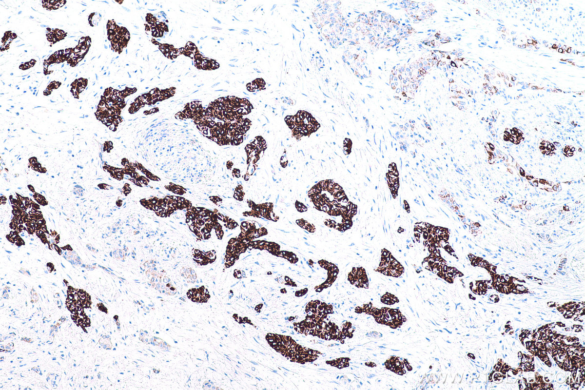 Immunohistochemical analysis of paraffin-embedded human urothelial carcinoma tissue slide using KHC0750 (KRT13 IHC Kit).