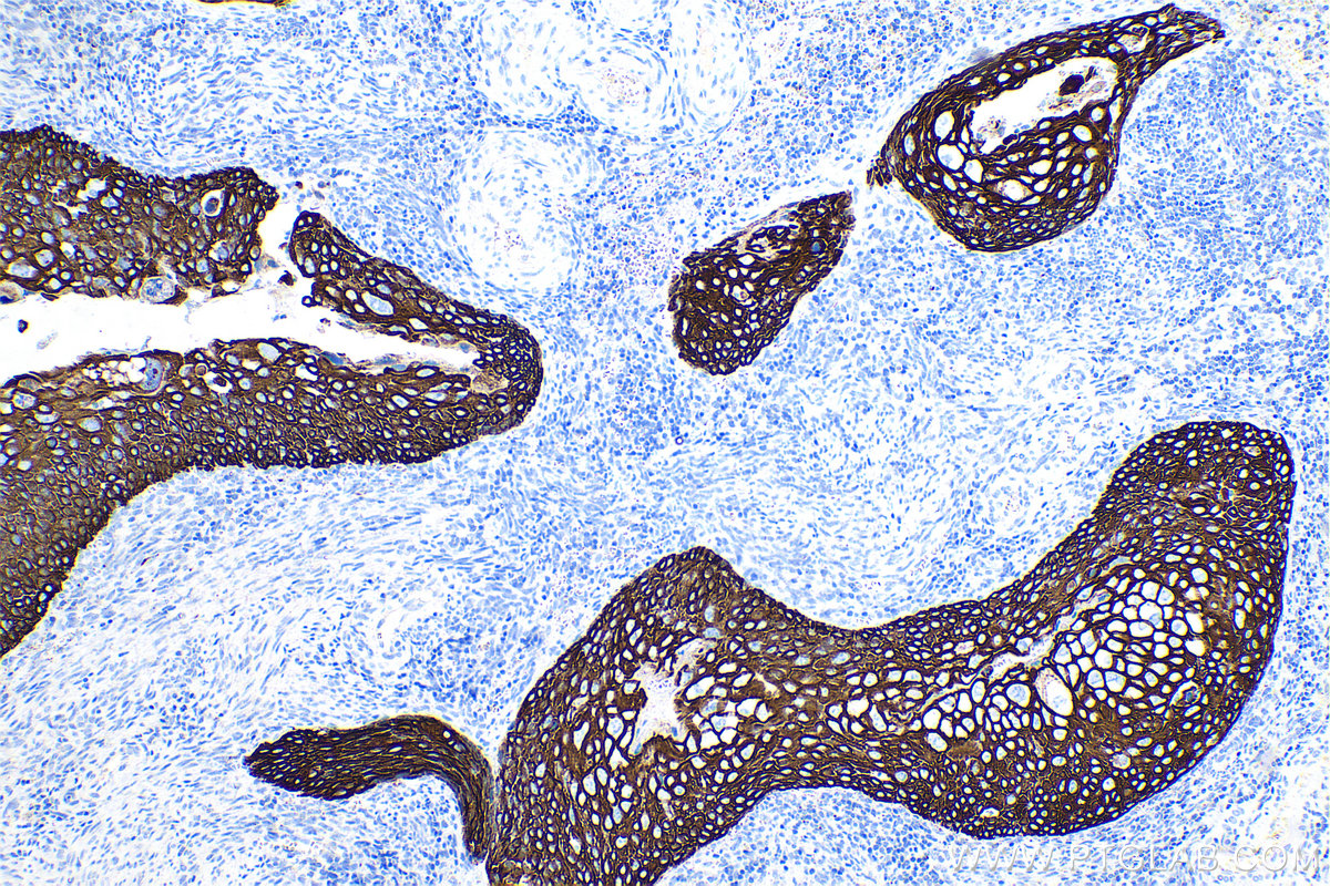 Immunohistochemical analysis of paraffin-embedded human cervical cancer tissue slide using KHC0752 (KRT15 IHC Kit).