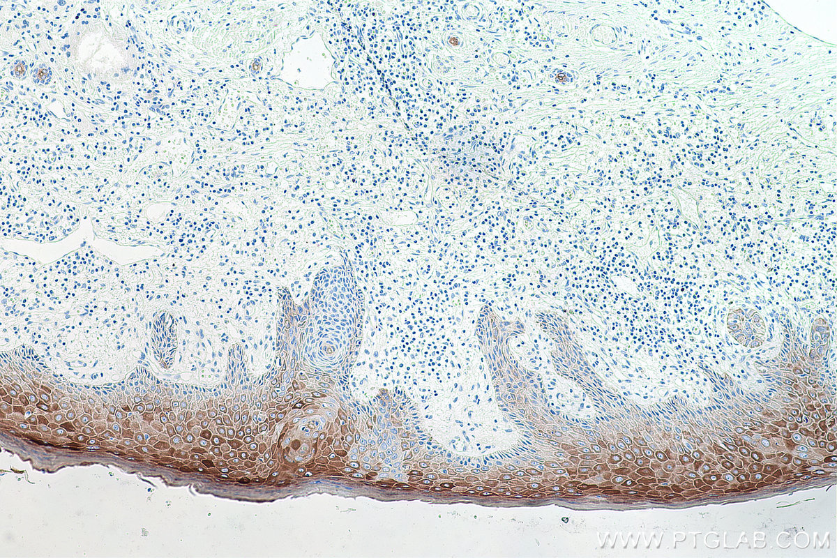 Immunohistochemical analysis of paraffin-embedded human skin cancer tissue slide using KHC0142 (Cytokeratin 16 IHC Kit).