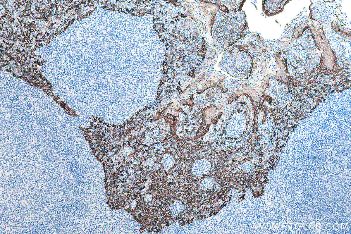 Immunohistochemical analysis of paraffin-embedded human tonsillitis tissue slide using KHC0142 (Cytokeratin 16 IHC Kit).