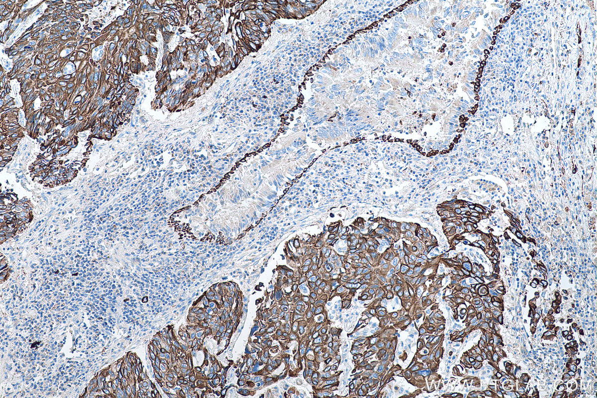 Immunohistochemical analysis of paraffin-embedded human lung cancer tissue slide using KHC0753 (KRT17 IHC Kit).