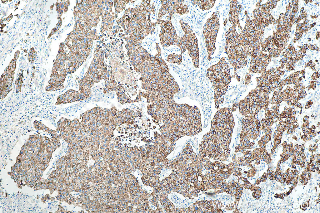 Immunohistochemical analysis of paraffin-embedded human breast cancer tissue slide using KHC0032 (Cytokeratin 18 IHC Kit).