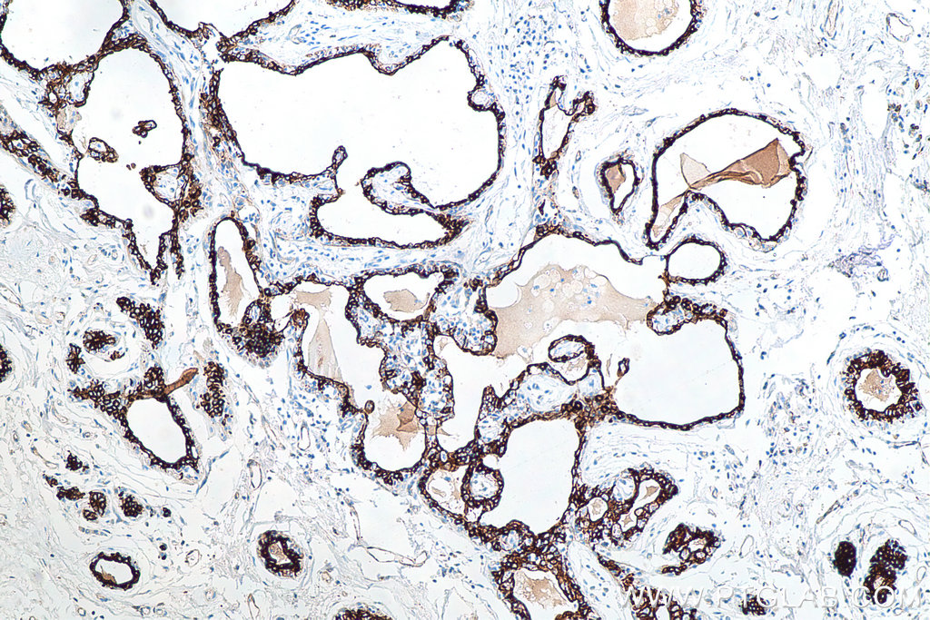 Immunohistochemical analysis of paraffin-embedded human breast cancer tissue slide using KHC0032 (Cytokeratin 18 IHC Kit).