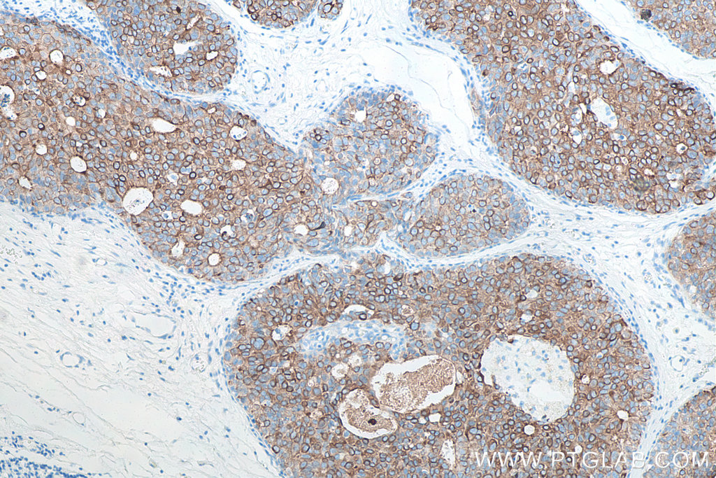 Immunohistochemical analysis of paraffin-embedded human breast cancer tissue slide using KHC0033 (Cytokeratin 19 IHC Kit)