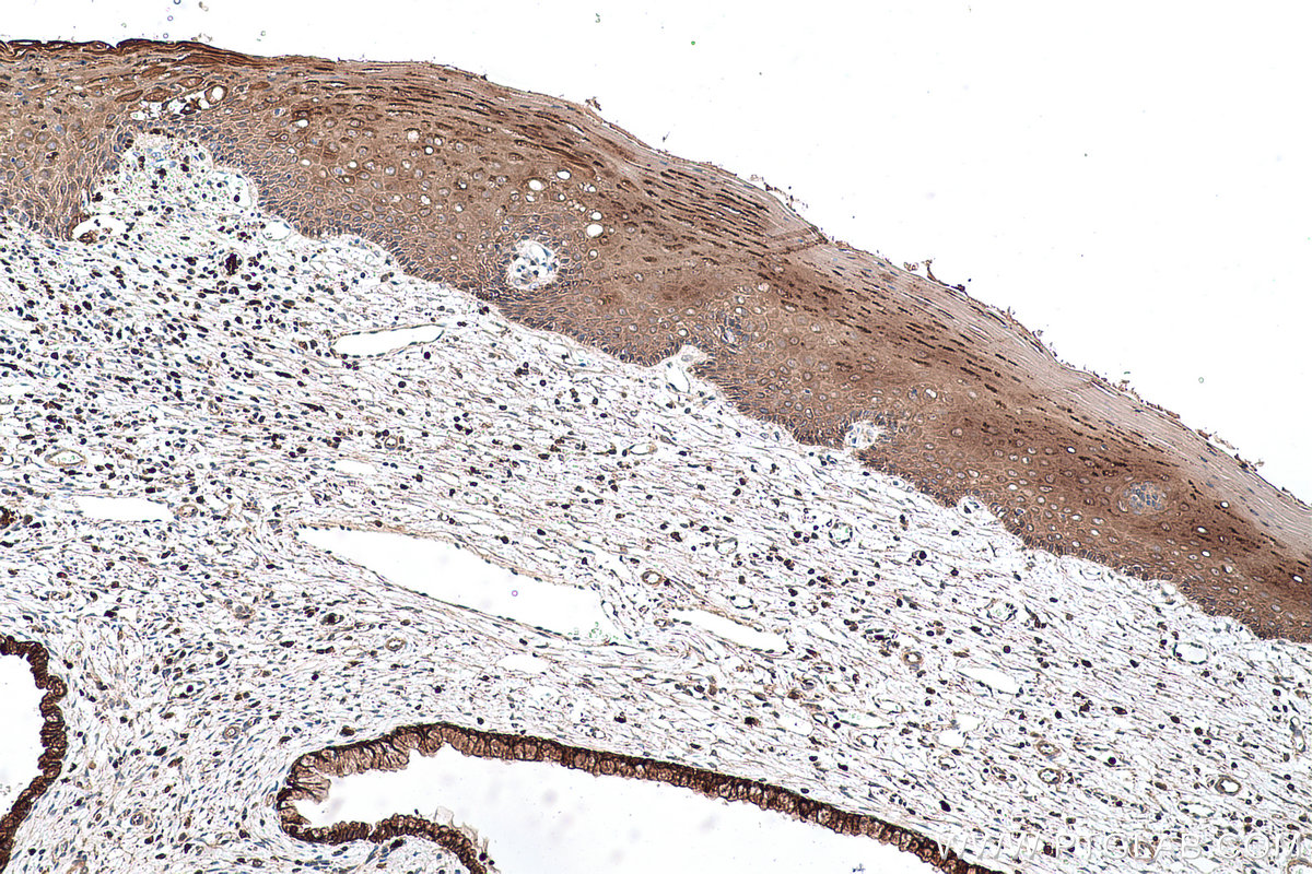 Immunohistochemical analysis of paraffin-embedded human cervical cancer tissue slide using KHC0745 (KRT2 IHC Kit).