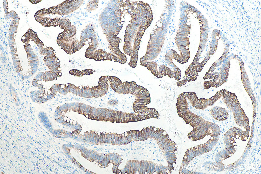 Immunohistochemical analysis of paraffin-embedded human colon cancer tissue slide using KHC0034 (Cytokeratin 20 IHC Kit).