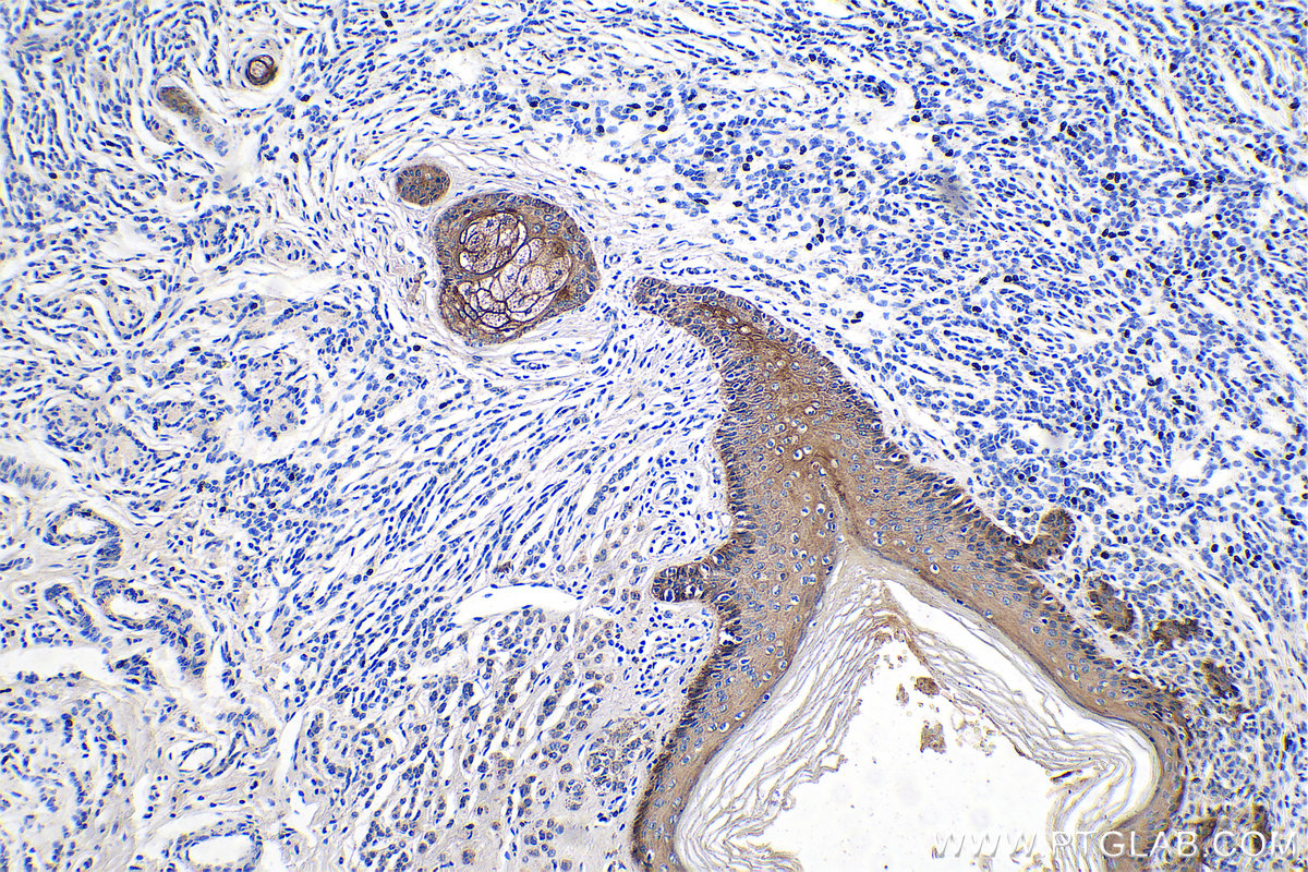 Immunohistochemical analysis of paraffin-embedded human malignant melanoma tissue slide using KHC0754 (KRT33B IHC Kit).